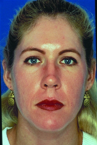 After Image: Facial Rejuvenation - front
