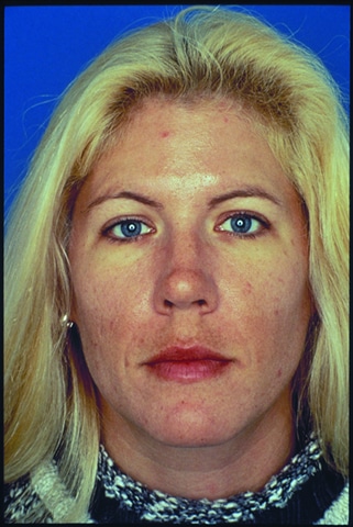 Before Image: Facial Rejuvenation - front