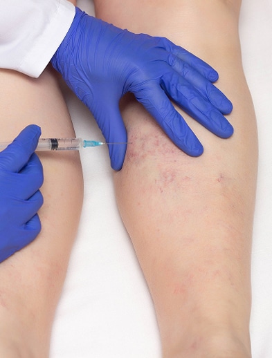 vein procedures@1.2x vein